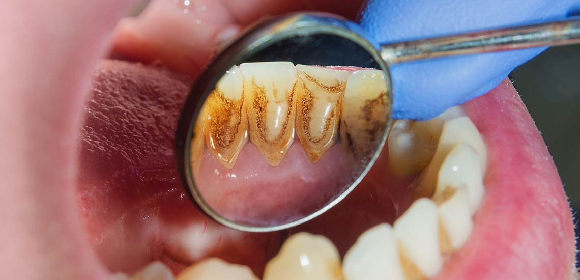 The 3-Minute Rule for Gum Disease